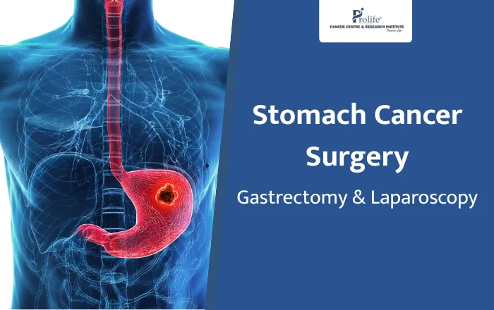 Surgery for Stomach Cancer Gastrectomy and Laparoscopic Options