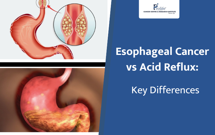 Esophageal Cancer vs Acid Reflux: Key Differences You Need to Know